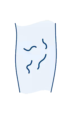 เส้นเลือดขอด