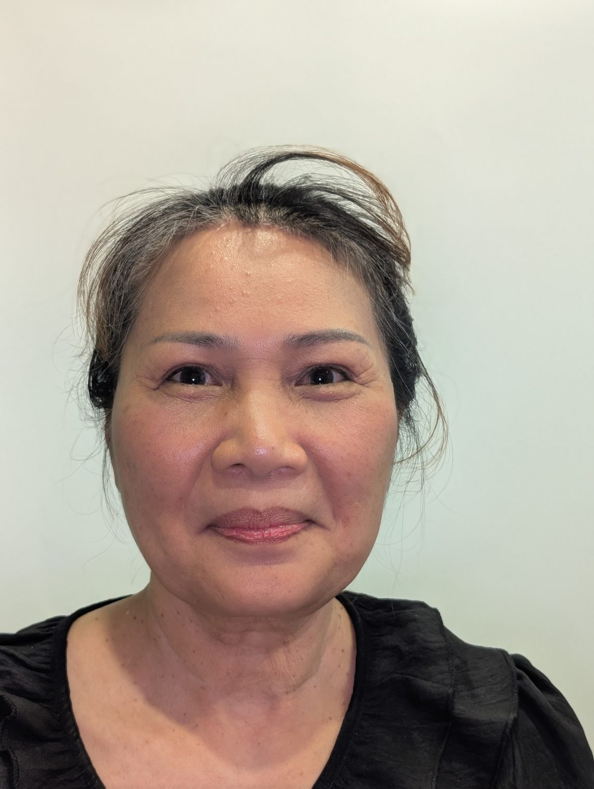 ดึงหน้าผากไรผม (Open Foreheadplasty)